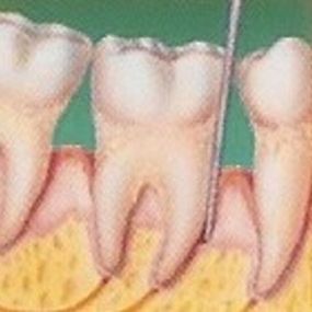 Fremskredene Periodontitt