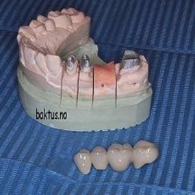 Det mangler en tann. Nabotennene slipes til. Tannteknikker lager broen med en kunstig tann.