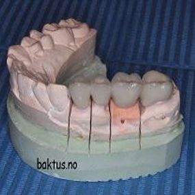 Broen sementeres på de to/ tre tennene som ble slipt til. Og man har fått erstattet manglende tann.